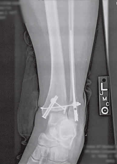 Broken_leg Broken leg with terminator-like hardware